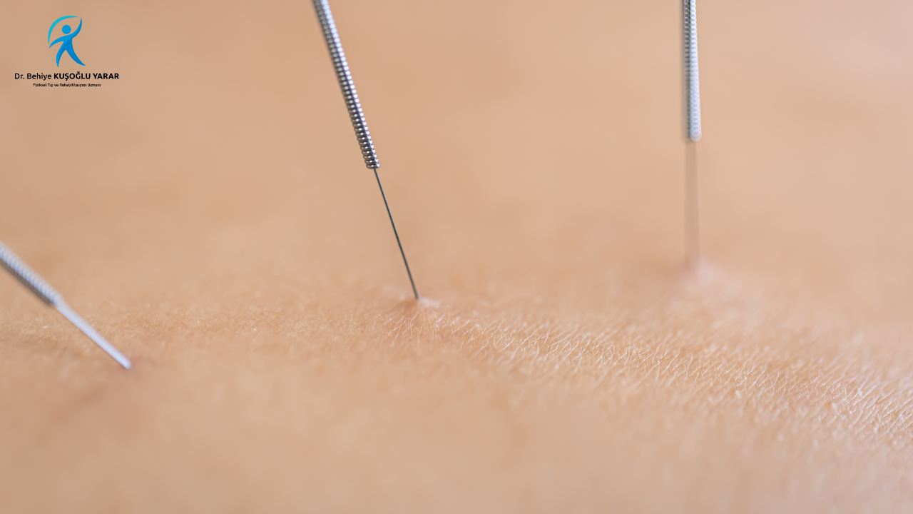 Konya Kuru İğneleme Tedavisi